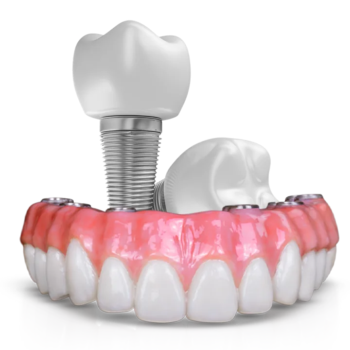 Modelo de prótese protocolo apoiada em implantes, ao lado de um implante unitário com coroa